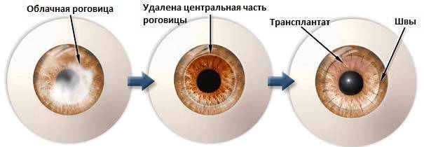 Расплывается в глазах: причины, почему мутнеет изображение, болезни, вызывающие кратковременные помутнения