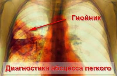 Абсцесс легкого с пневмонией исход