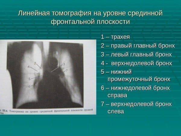 Сегментарная пневмония