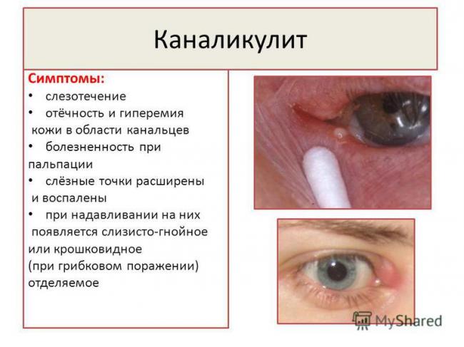 Воспаление глаза - виды, симптомы, лечение