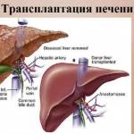 Сколько живут после трансплантации печени при циррозе?