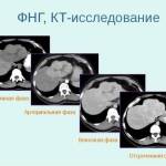 Фокальная нодулярная гиперплазия печени: что это такое?