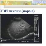 Расшифровка УЗИ печени: основные показатели нормы