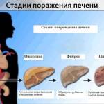 Первые признаки цирроза печени у женщин