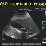 Чем лечить застой желчи в желчном пузыре?