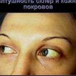 Желтуха это какой гепатит, A или B?