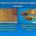Что такое первичный и вторничный билиарный цирроз печени?